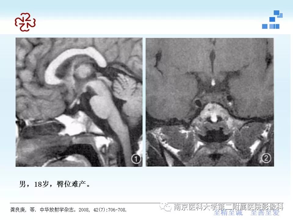 【PPT】专题读片—垂体柄阻断综合征