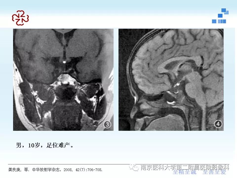 【PPT】专题读片—垂体柄阻断综合征