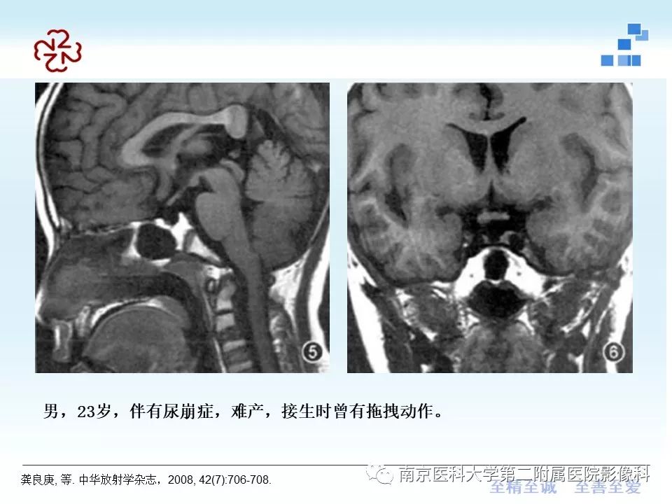 【PPT】专题读片—垂体柄阻断综合征