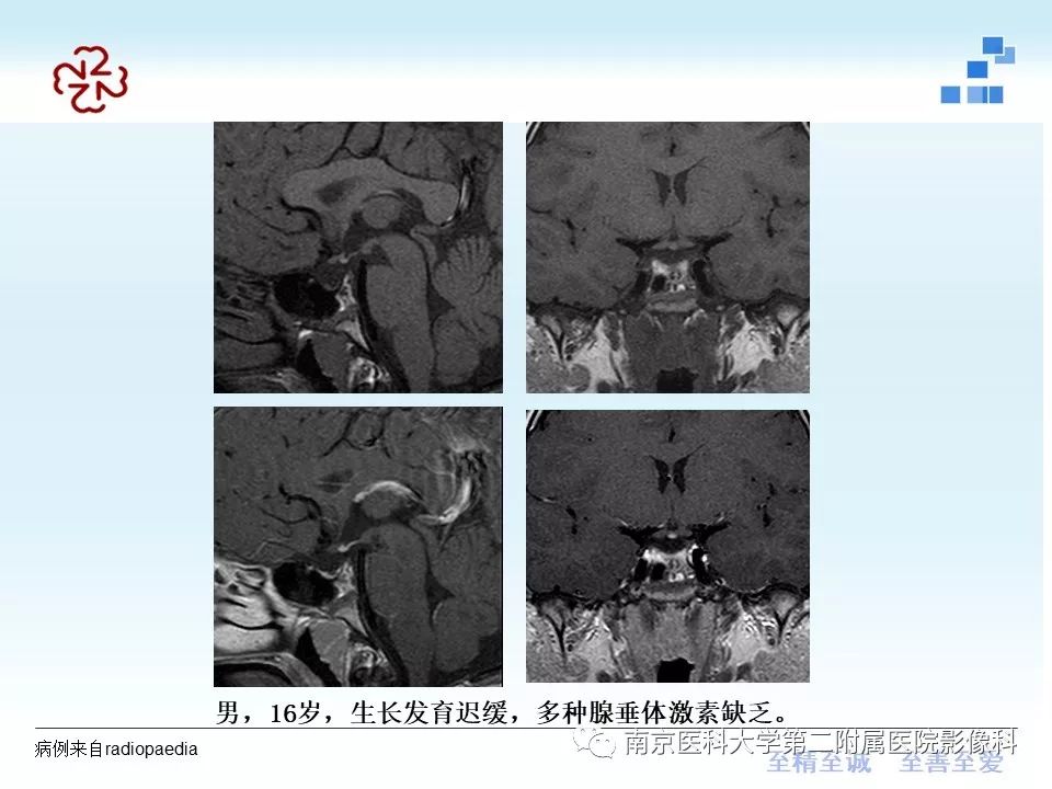 【PPT】专题读片—垂体柄阻断综合征