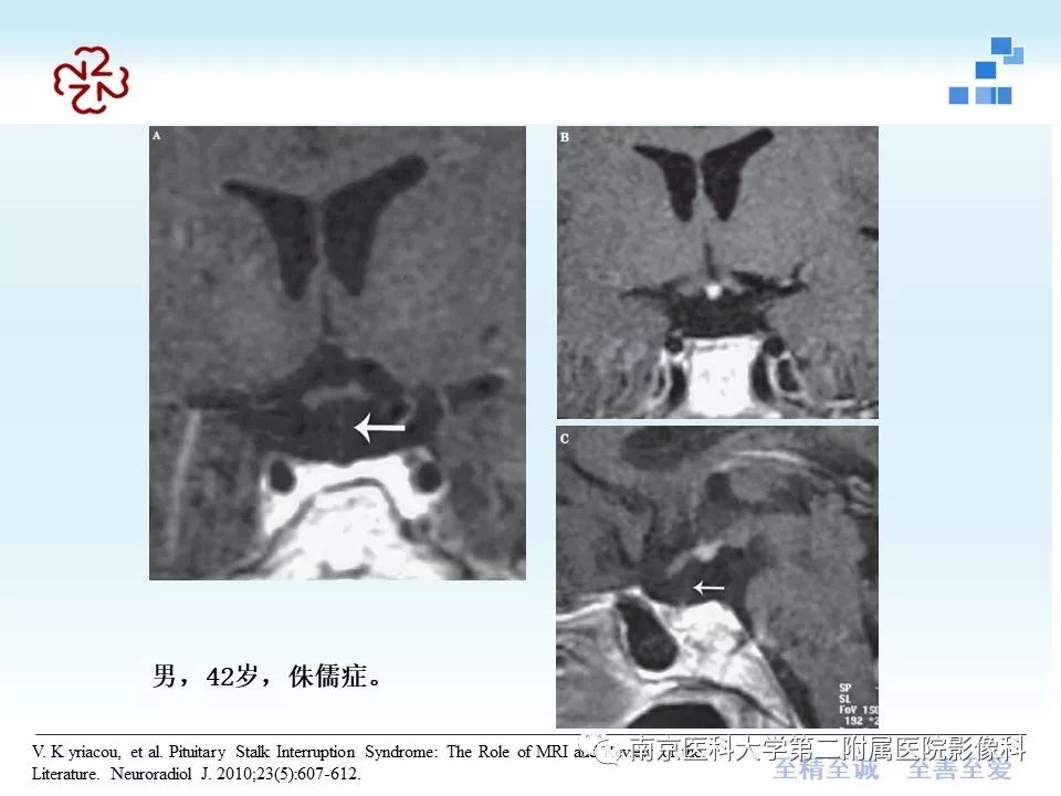 【PPT】专题读片—垂体柄阻断综合征