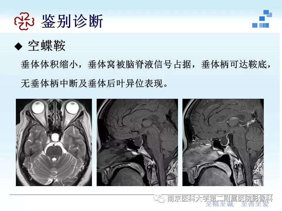 【PPT】专题读片—垂体柄阻断综合征