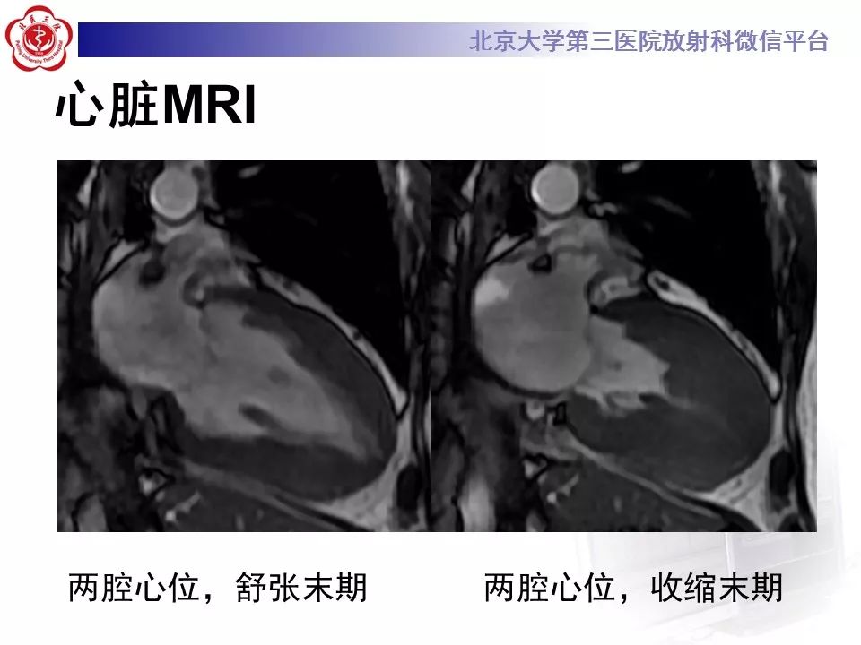 【病例】肥厚性心肌病1例MR