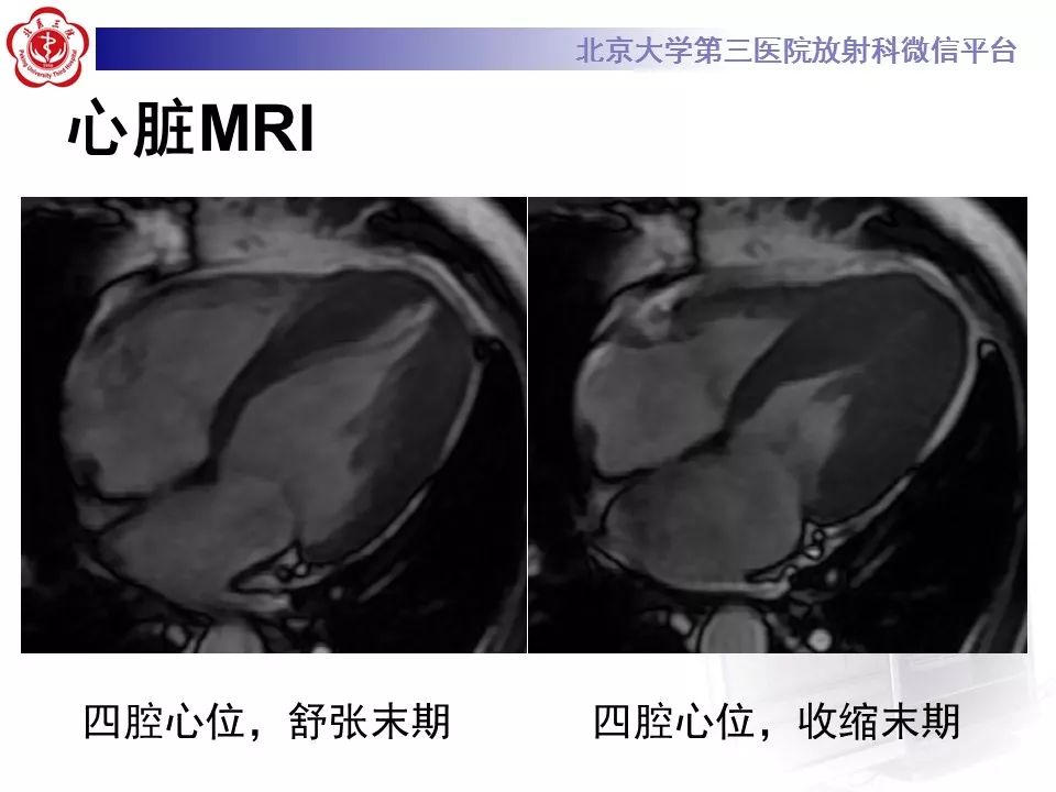 【病例】肥厚性心肌病1例MR