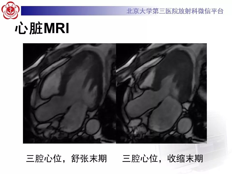 【病例】肥厚性心肌病1例MR