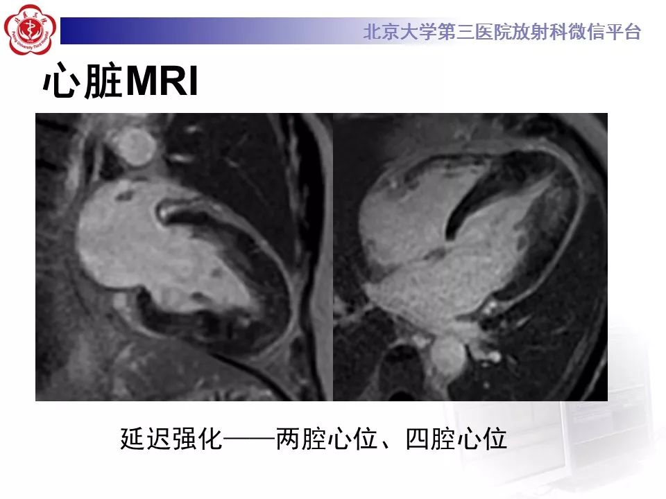 【病例】肥厚性心肌病1例MR