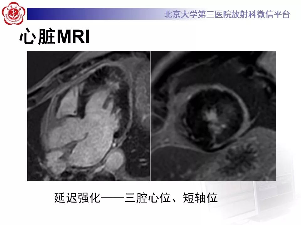【病例】肥厚性心肌病1例MR