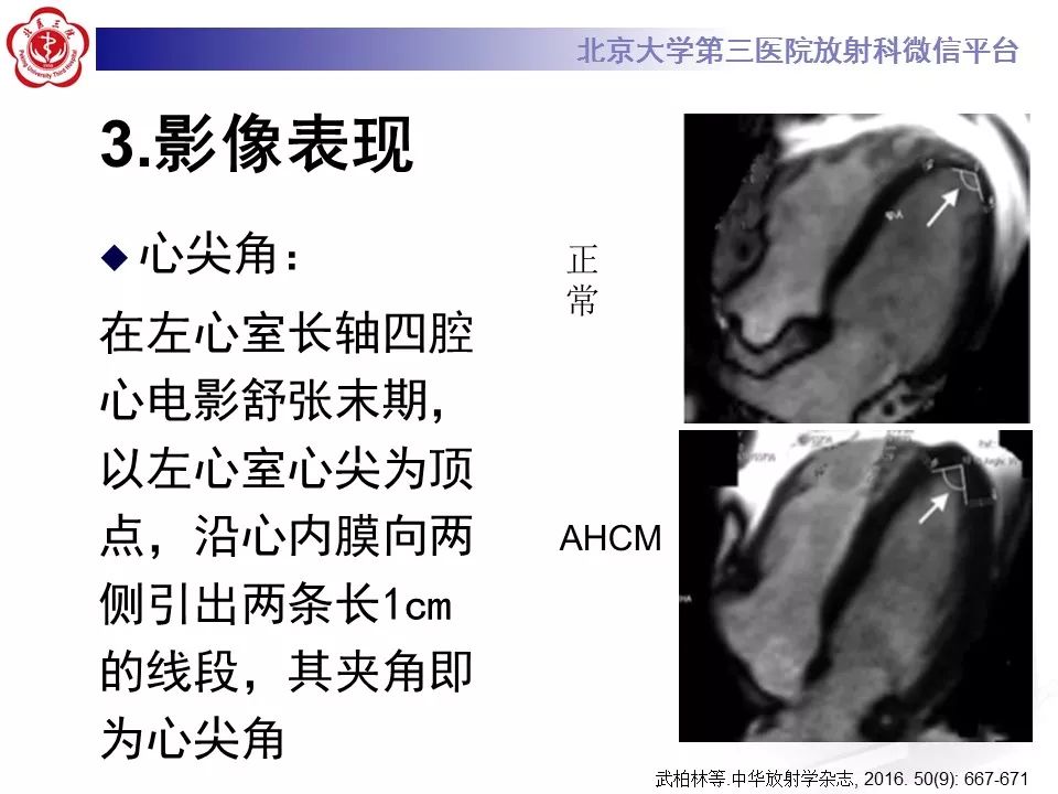 【病例】肥厚性心肌病1例MR