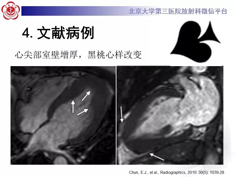 【病例】肥厚性心肌病1例MR