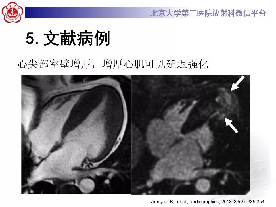 【病例】肥厚性心肌病1例MR