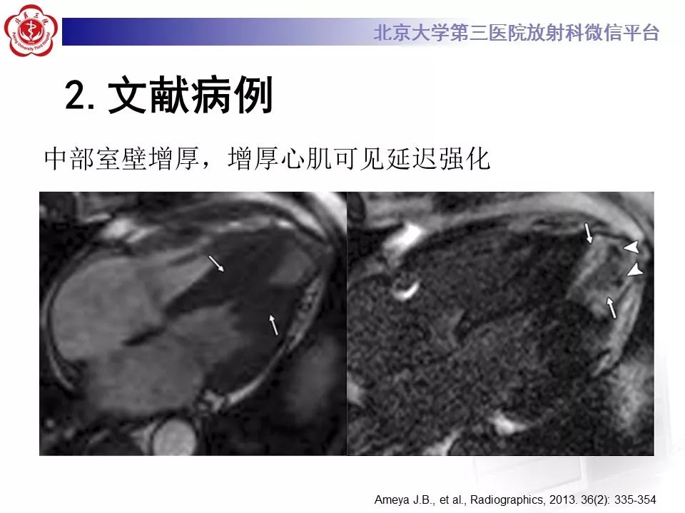 【病例】肥厚性心肌病1例MR