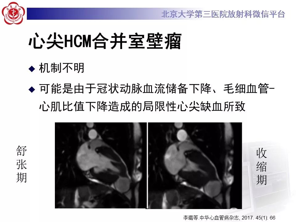 【病例】肥厚性心肌病1例MR