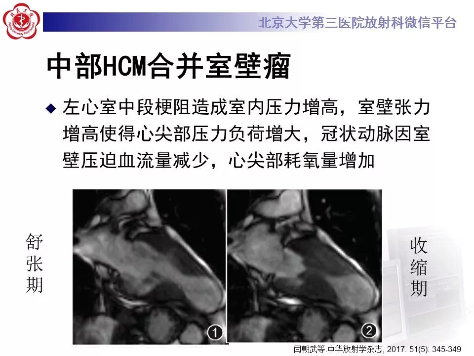 【病例】肥厚性心肌病1例MR