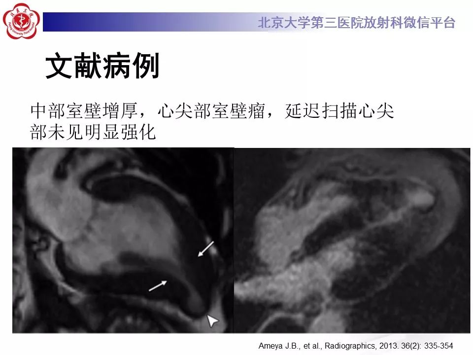 【病例】肥厚性心肌病1例MR