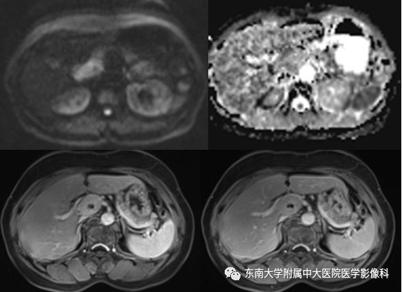 【病例】腹膜后巨淋巴结增生症VS炎性肌纤维母细胞瘤 【病例】腹膜后巨淋巴结增生症VS炎性肌纤维母细胞瘤