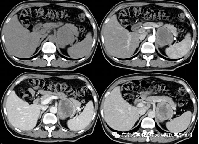 【病例】腹膜后巨淋巴结增生症VS炎性肌纤维母细胞瘤 【病例】腹膜后巨淋巴结增生症VS炎性肌纤维母细胞瘤