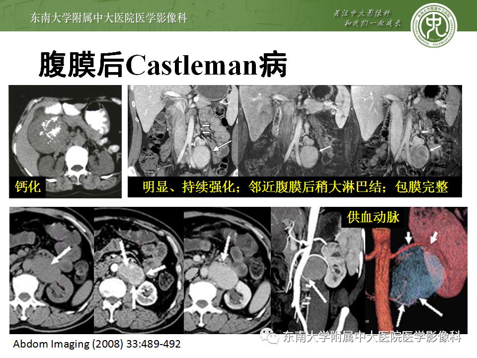 【病例】腹膜后巨淋巴结增生症VS炎性肌纤维母细胞瘤 【病例】腹膜后巨淋巴结增生症VS炎性肌纤维母细胞瘤