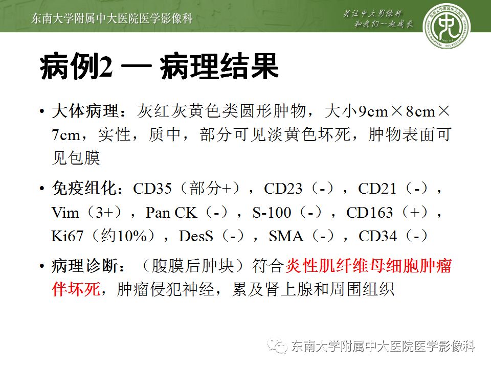 【病例】腹膜后巨淋巴结增生症VS炎性肌纤维母细胞瘤 【病例】腹膜后巨淋巴结增生症VS炎性肌纤维母细胞瘤