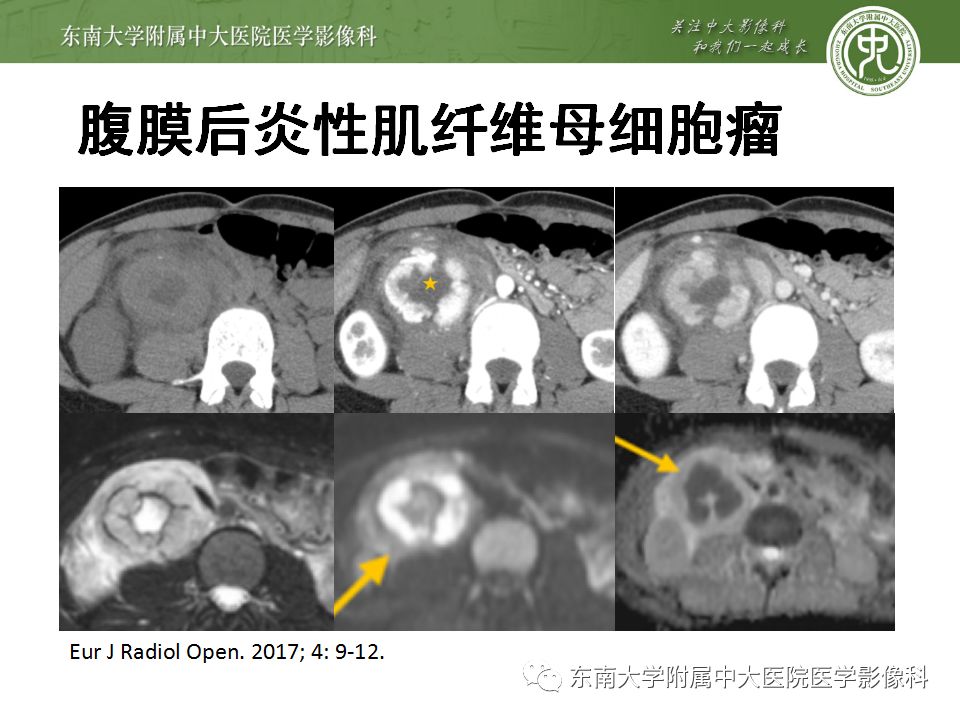 【病例】腹膜后巨淋巴结增生症VS炎性肌纤维母细胞瘤 【病例】腹膜后巨淋巴结增生症VS炎性肌纤维母细胞瘤