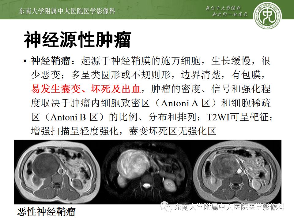 【病例】腹膜后巨淋巴结增生症VS炎性肌纤维母细胞瘤 【病例】腹膜后巨淋巴结增生症VS炎性肌纤维母细胞瘤