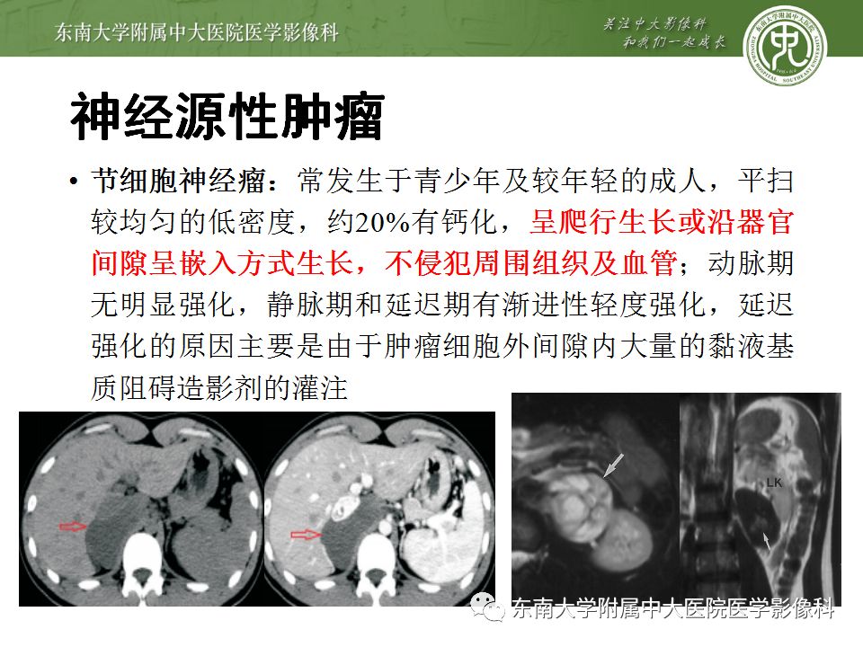 【病例】腹膜后巨淋巴结增生症VS炎性肌纤维母细胞瘤 【病例】腹膜后巨淋巴结增生症VS炎性肌纤维母细胞瘤