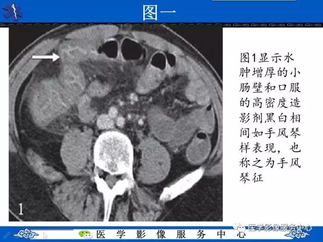 【影像征象】手风琴征