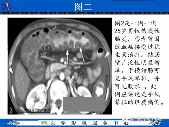【影像征象】手风琴征