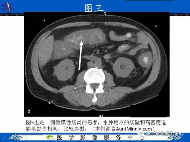 【影像征象】手风琴征