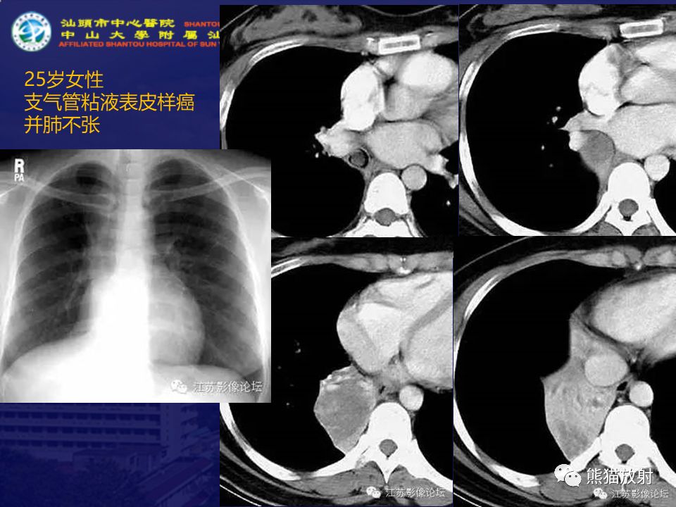 【病例】气管支气管粘液表皮样癌1例CT