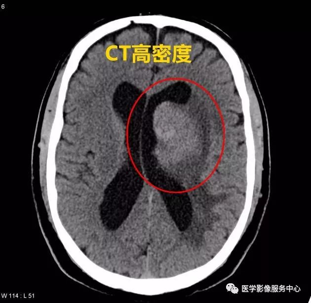 掌握4个要点,秒杀颅内淋巴瘤 掌握4个要点,秒杀颅内淋巴瘤