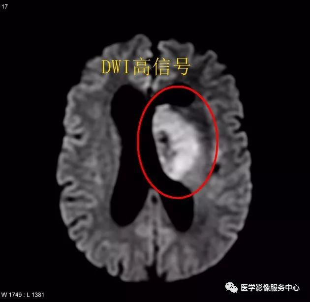 掌握4个要点,秒杀颅内淋巴瘤 掌握4个要点,秒杀颅内淋巴瘤
