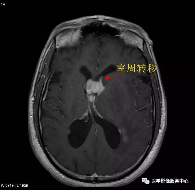 掌握4个要点,秒杀颅内淋巴瘤 掌握4个要点,秒杀颅内淋巴瘤