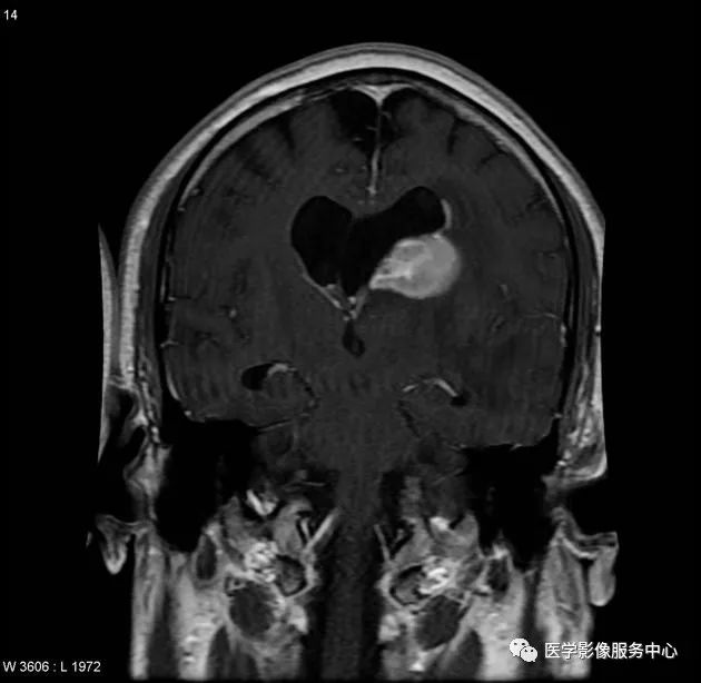 掌握4个要点,秒杀颅内淋巴瘤 掌握4个要点,秒杀颅内淋巴瘤