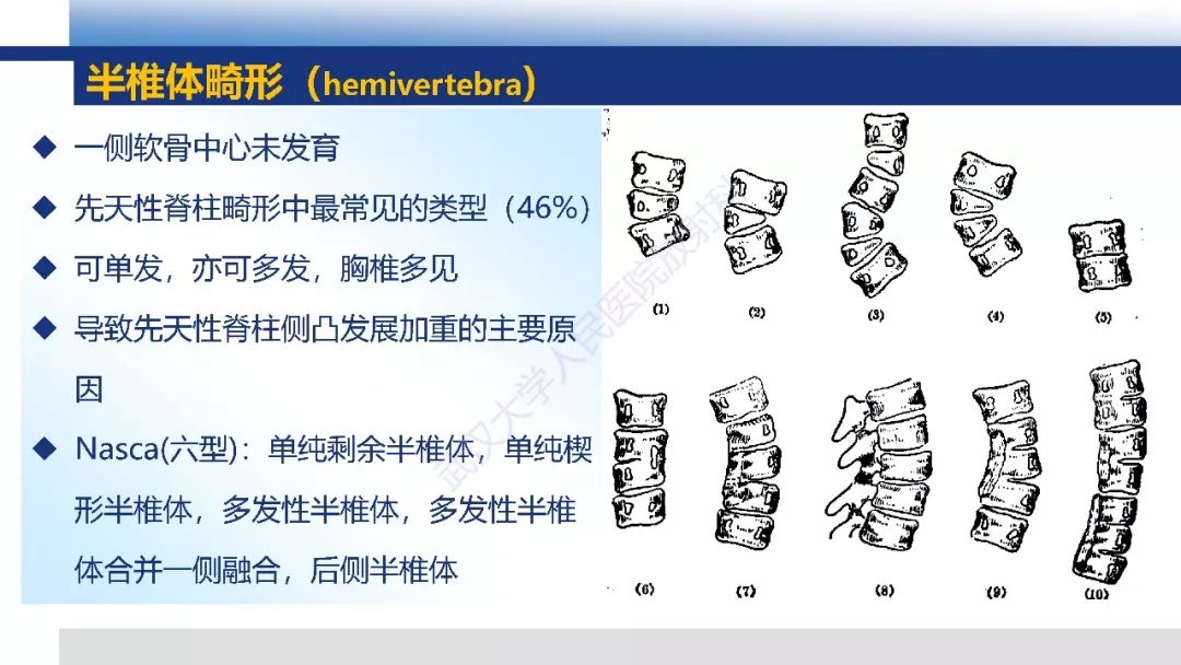 【PPT】先天性椎体畸形影像诊断