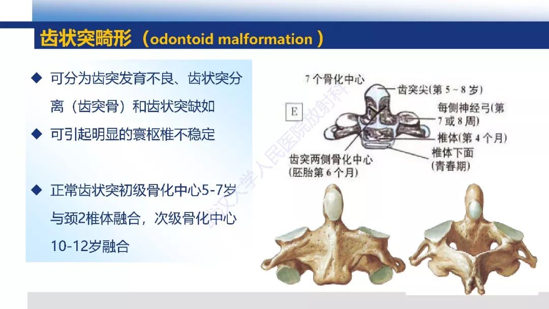【PPT】先天性椎体畸形影像诊断