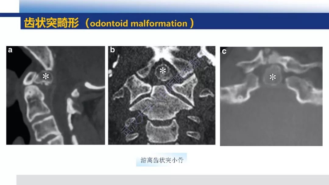 【PPT】先天性椎体畸形影像诊断