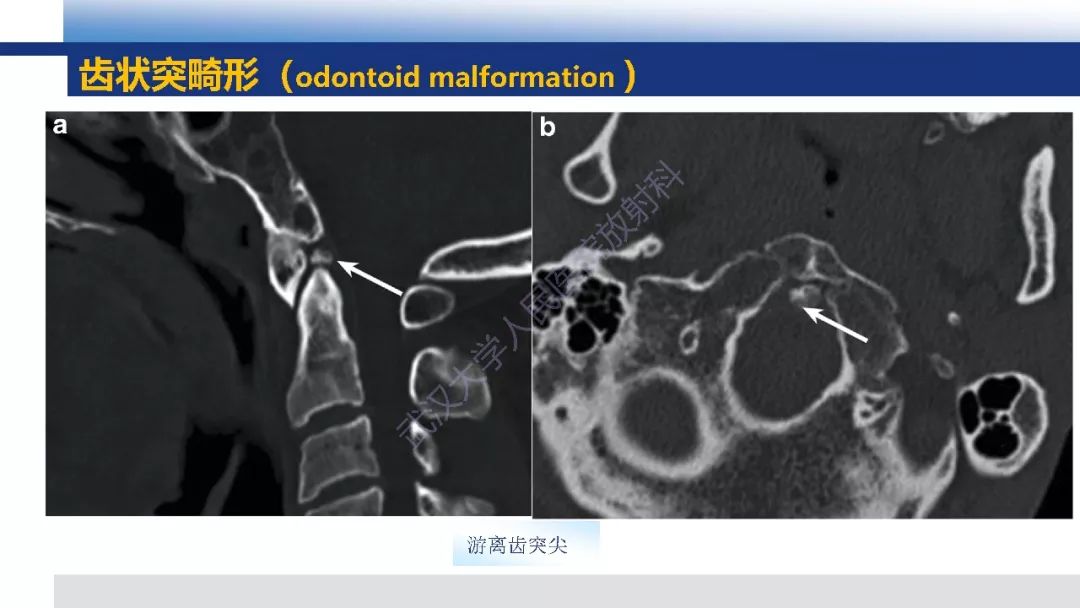 【PPT】先天性椎体畸形影像诊断