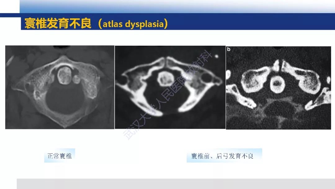 【PPT】先天性椎体畸形影像诊断