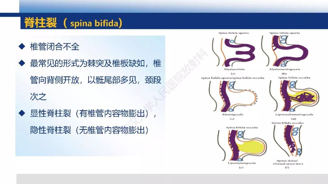 【PPT】先天性椎体畸形影像诊断