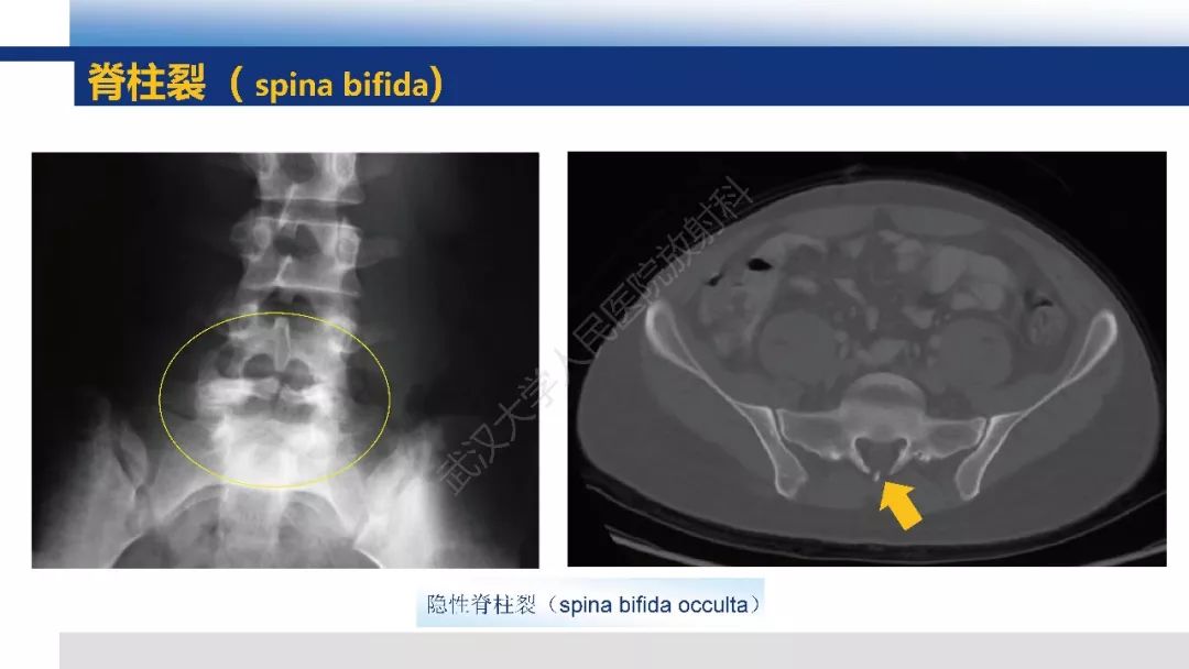 【PPT】先天性椎体畸形影像诊断