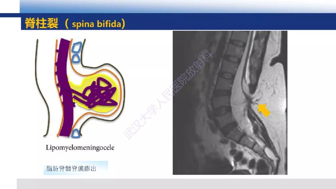 【PPT】先天性椎体畸形影像诊断