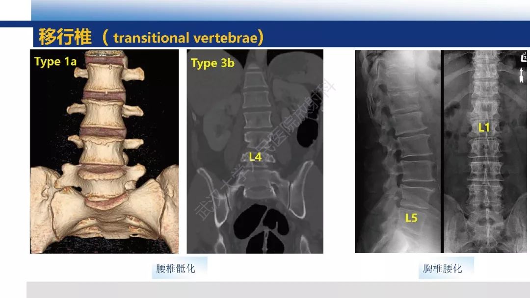 【PPT】先天性椎体畸形影像诊断