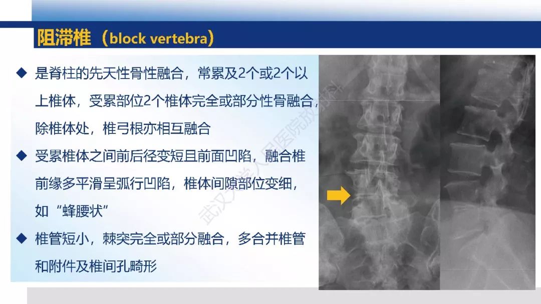【PPT】先天性椎体畸形影像诊断