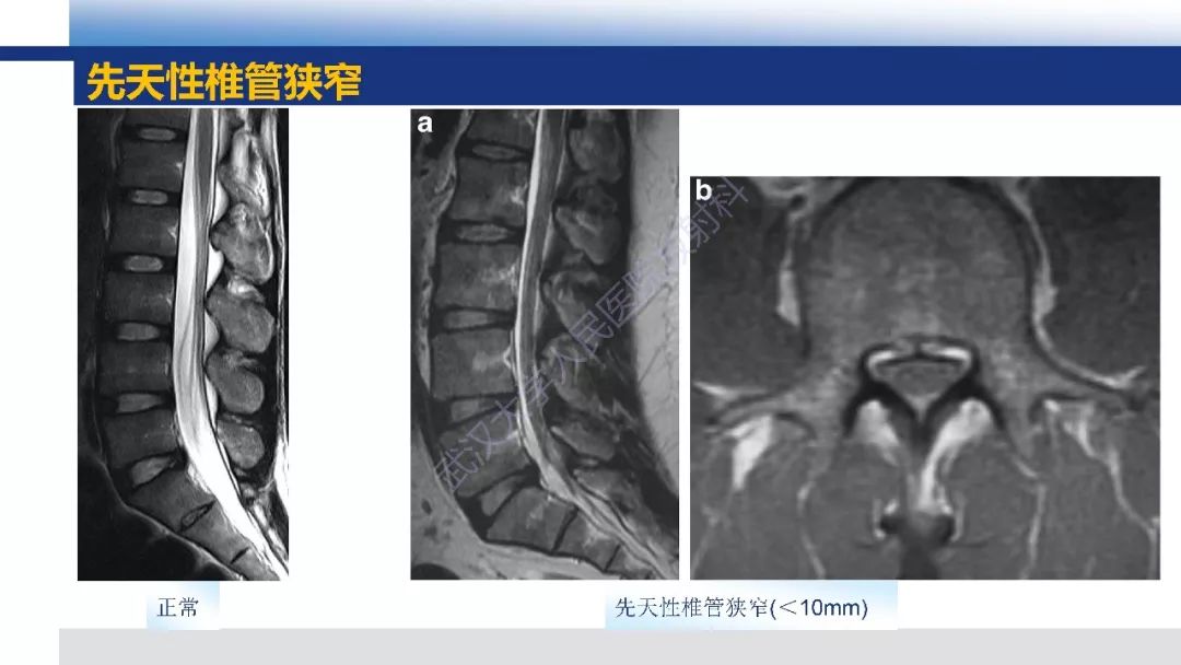 【PPT】先天性椎体畸形影像诊断