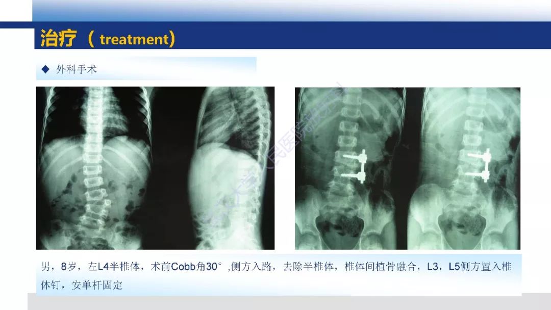 【PPT】先天性椎体畸形影像诊断