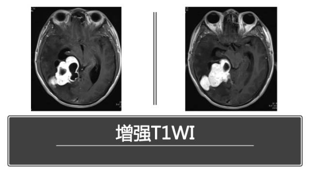 【病例】中枢神经系统窦组织细胞增生症RDD一例 【病例】中枢神经系统窦组织细胞增生症RDD一例