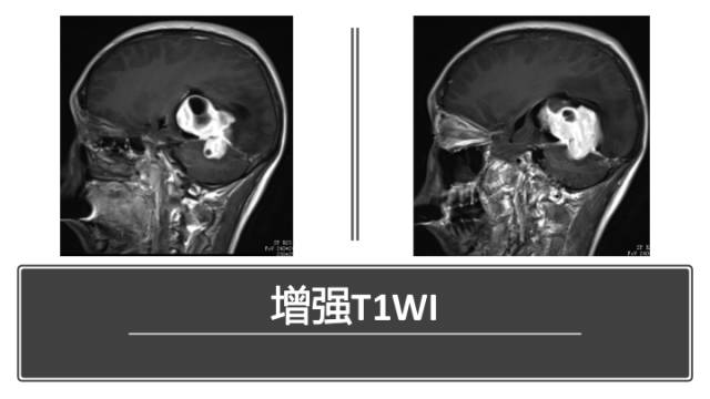 【病例】中枢神经系统窦组织细胞增生症RDD一例 【病例】中枢神经系统窦组织细胞增生症RDD一例