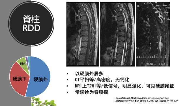 【病例】中枢神经系统窦组织细胞增生症RDD一例 【病例】中枢神经系统窦组织细胞增生症RDD一例