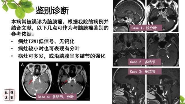 【病例】中枢神经系统窦组织细胞增生症RDD一例 【病例】中枢神经系统窦组织细胞增生症RDD一例