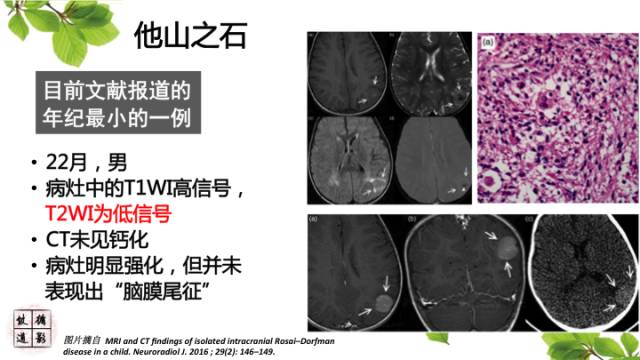 【病例】中枢神经系统窦组织细胞增生症RDD一例 【病例】中枢神经系统窦组织细胞增生症RDD一例